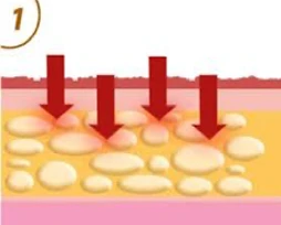 Chiropractic Goleta CA Invisa Red 1 Step One of InvisaRED therapy, showing inflammation of adipose cells