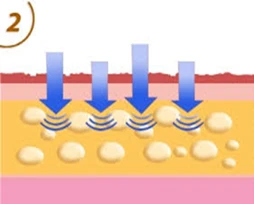 Chiropractic Goleta CA Invisa Red 2 Step 2 of InvisaRED therapy, showing adipose cells decreasing in size